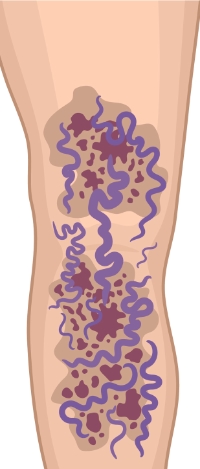 ulcers